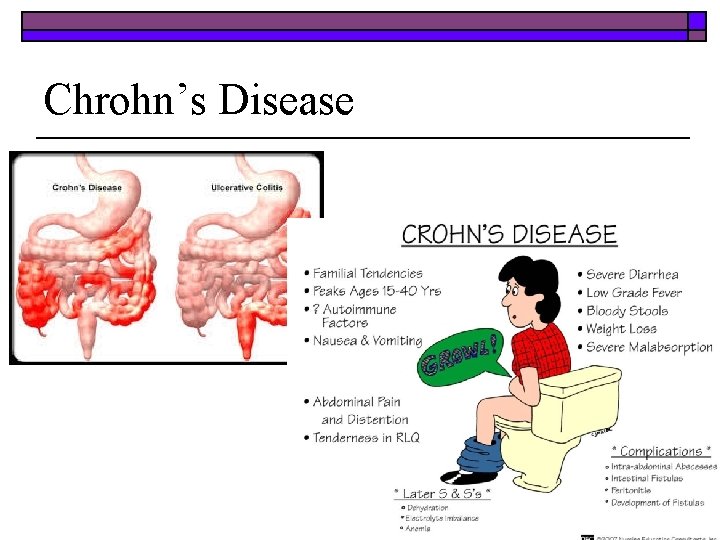 Chrohn’s Disease 