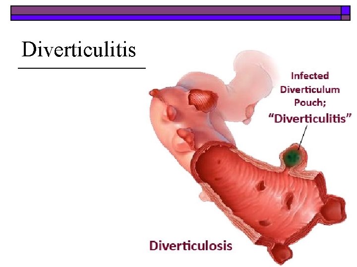 Diverticulitis 