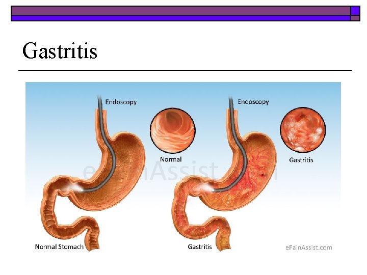 Gastritis 