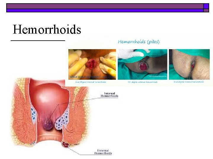 Hemorrhoids 