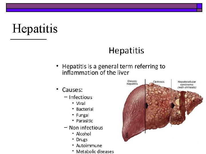 Hepatitis 