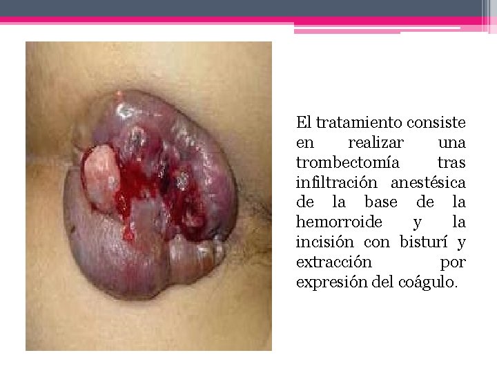 El tratamiento consiste en realizar una trombectomía tras infiltración anestésica de la base de