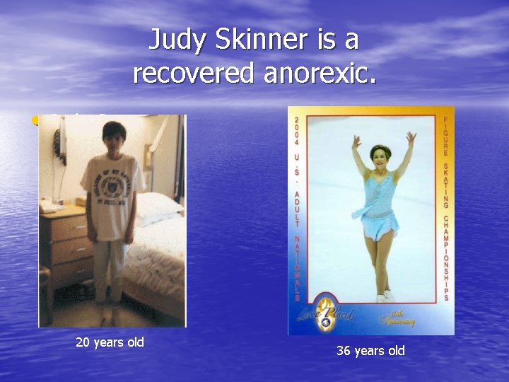 Judy Skinner is a recovered anorexic. • Judy Sargent 20 years old 36 years