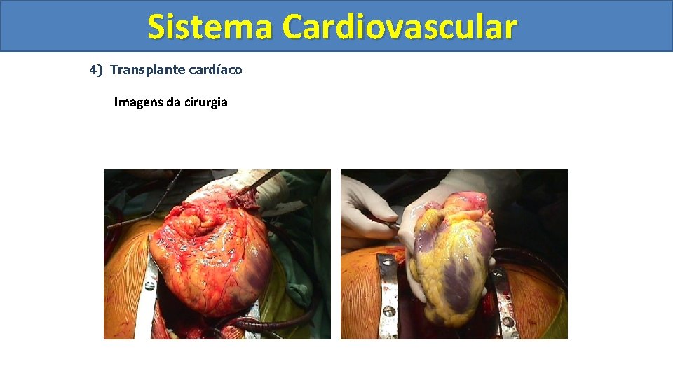 Sistema Cardiovascular Circulatório 4) Transplante cardíaco Imagens da cirurgia Sistema Cardiovascular Circulatório 4) Transplante cardíaco Imagens da cirurgia