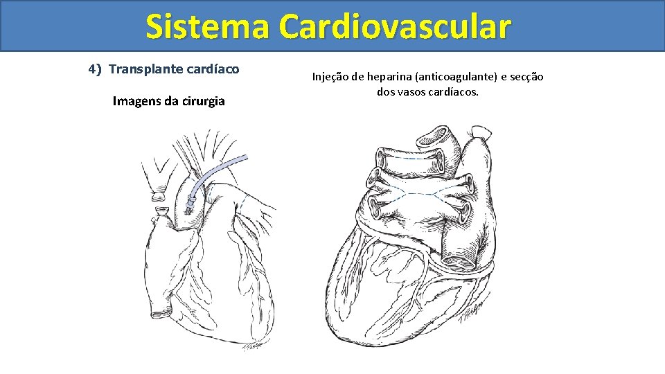 Sistema Cardiovascular Circulatório 4) Transplante cardíaco Imagens da cirurgia Injeção de heparina (anticoagulante) e Sistema Cardiovascular Circulatório 4) Transplante cardíaco Imagens da cirurgia Injeção de heparina (anticoagulante) e