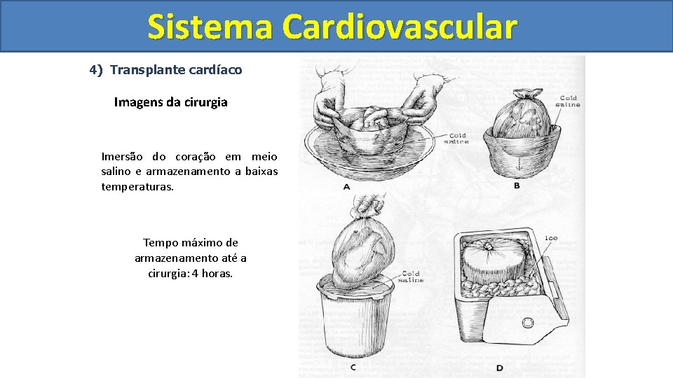 Sistema Cardiovascular Circulatório 4) Transplante cardíaco Imagens da cirurgia Imersão do coração em meio Sistema Cardiovascular Circulatório 4) Transplante cardíaco Imagens da cirurgia Imersão do coração em meio