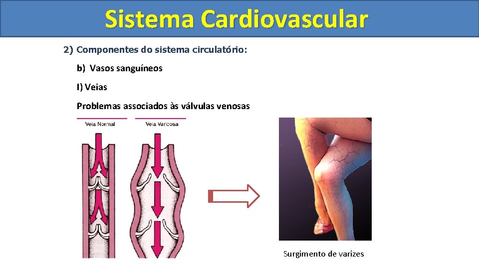 Sistema Cardiovascular Circulatório 2) Componentes do sistema circulatório: b) Vasos sanguíneos I) Veias Problemas Sistema Cardiovascular Circulatório 2) Componentes do sistema circulatório: b) Vasos sanguíneos I) Veias Problemas