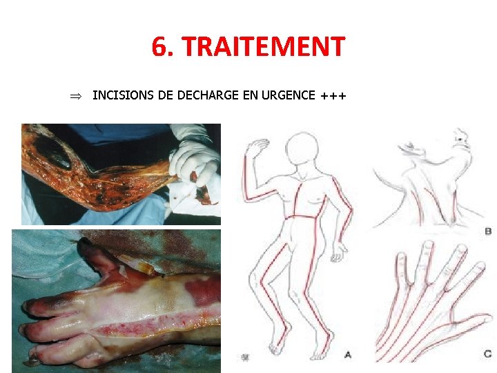 6. TRAITEMENT Þ INCISIONS DE DECHARGE EN URGENCE +++ 36 