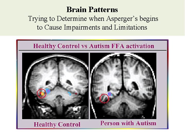 Brain Patterns Trying to Determine when Asperger’s begins to Cause Impairments and Limitations Brain Patterns Trying to Determine when Asperger’s begins to Cause Impairments and Limitations