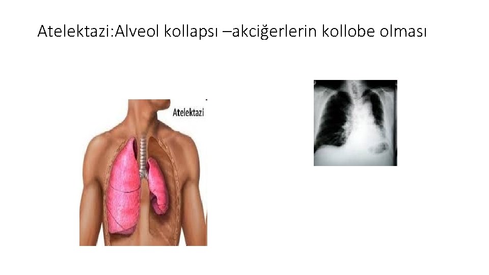 Atelektazi: Alveol kollapsı –akciğerlerin kollobe olması 