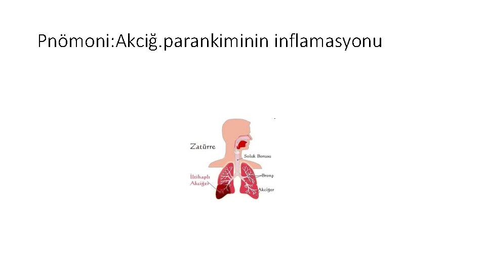 Pnömoni: Akciğ. parankiminin inflamasyonu 