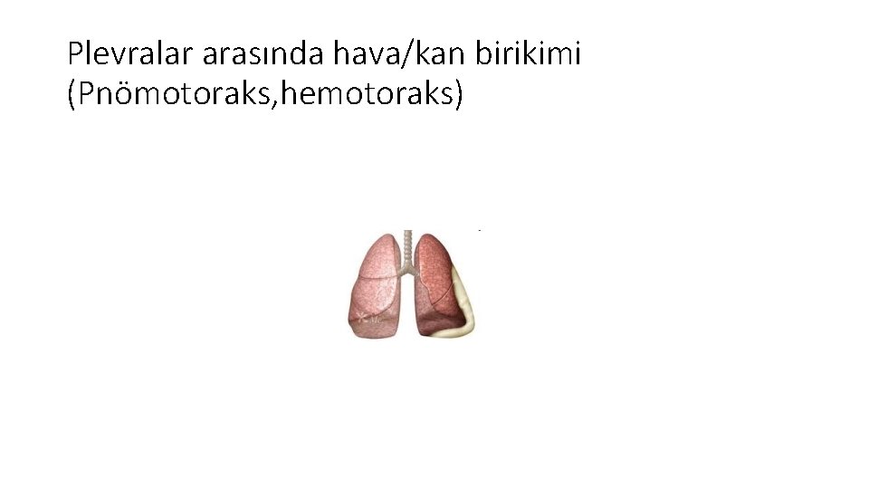 Plevralar arasında hava/kan birikimi (Pnömotoraks, hemotoraks) 