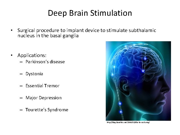 Deep Brain Stimulation • Surgical procedure to implant device to stimulate subthalamic nucleus in