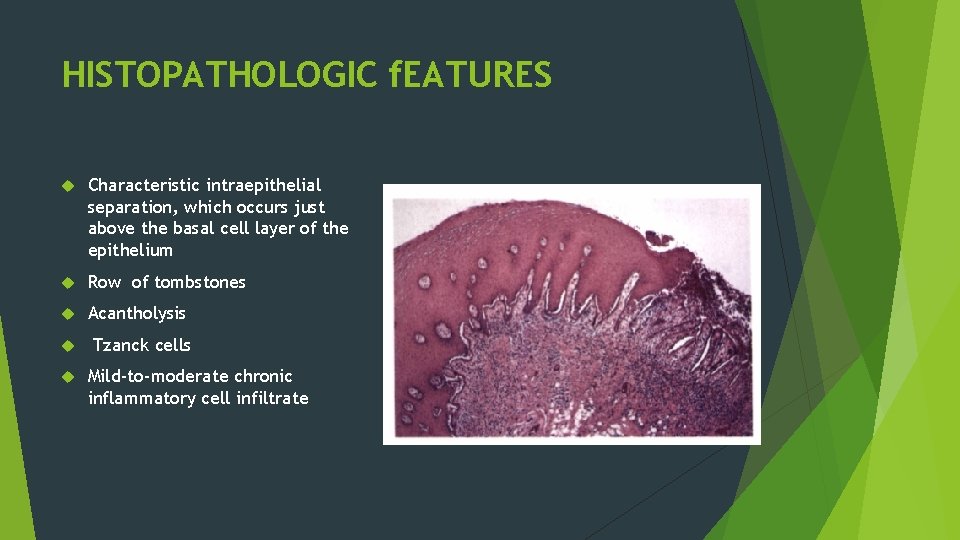 HISTOPATHOLOGIC f. EATURES Characteristic intraepithelial separation, which occurs just above the basal cell layer