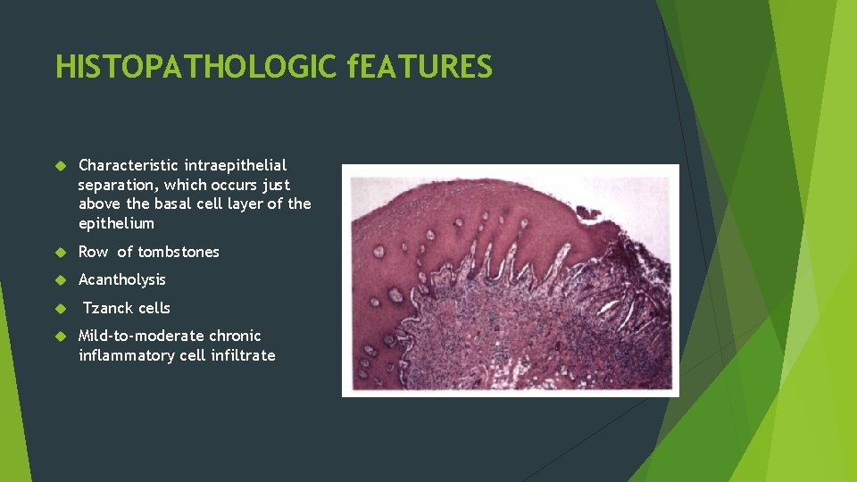 HISTOPATHOLOGIC f. EATURES Characteristic intraepithelial separation, which occurs just above the basal cell layer HISTOPATHOLOGIC f. EATURES Characteristic intraepithelial separation, which occurs just above the basal cell layer