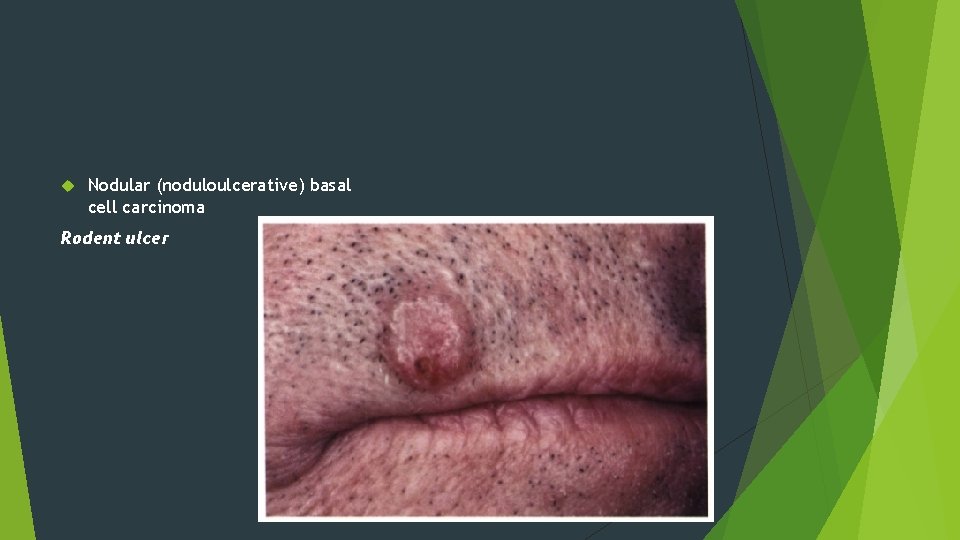  Nodular (noduloulcerative) basal cell carcinoma Rodent ulcer 