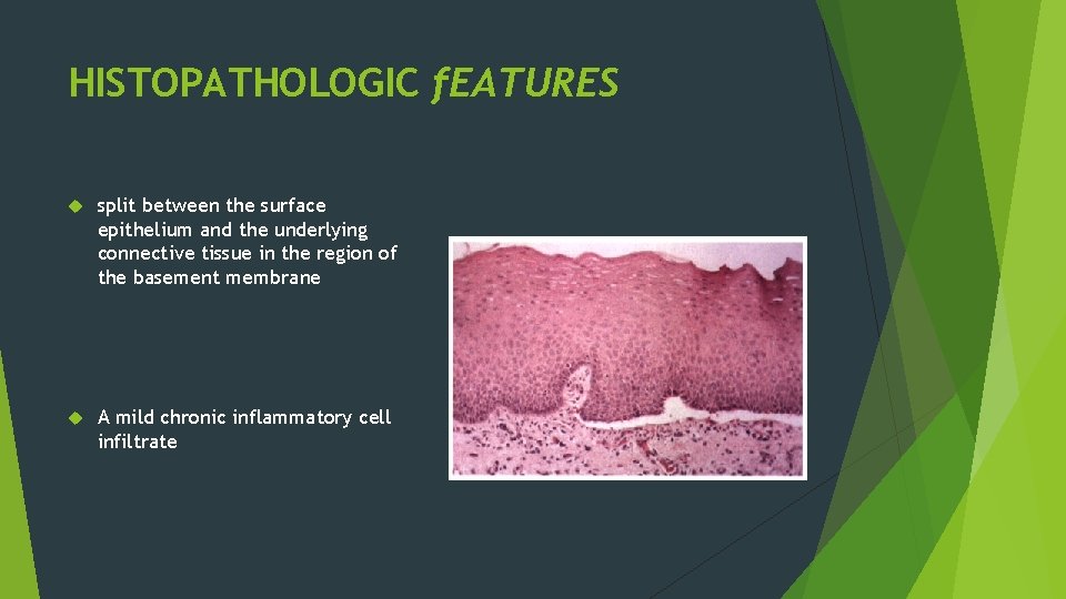 HISTOPATHOLOGIC f. EATURES split between the surface epithelium and the underlying connective tissue in HISTOPATHOLOGIC f. EATURES split between the surface epithelium and the underlying connective tissue in