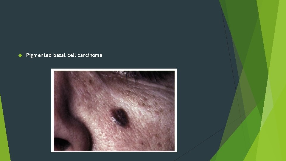  Pigmented basal cell carcinoma 