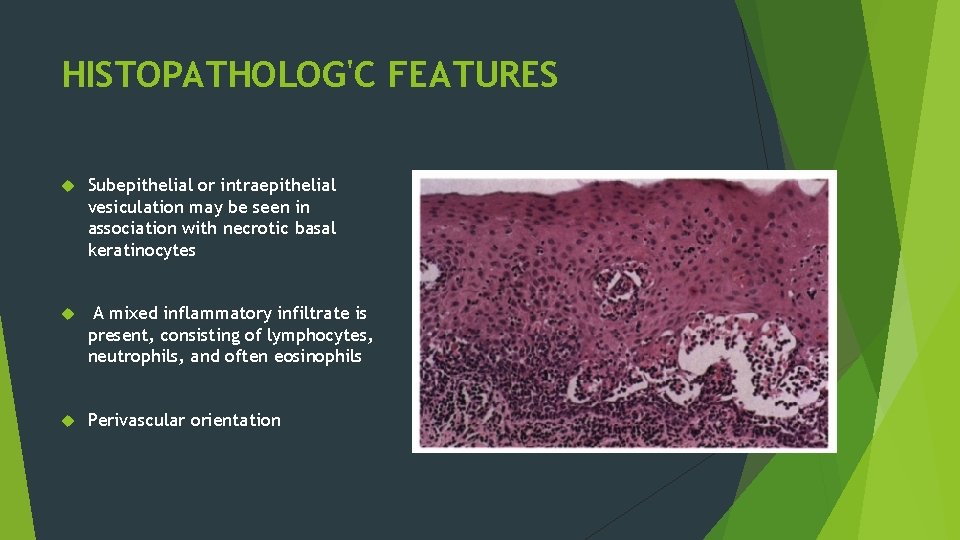 HISTOPATHOLOG'C FEATURES Subepithelial or intraepithelial vesiculation may be seen in association with necrotic basal HISTOPATHOLOG'C FEATURES Subepithelial or intraepithelial vesiculation may be seen in association with necrotic basal