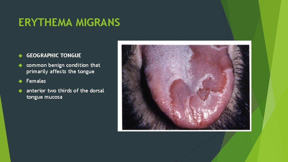 ERYTHEMA MIGRANS GEOGRAPHIC TONGUE common benign condition that primarily affects the tongue Females anterior