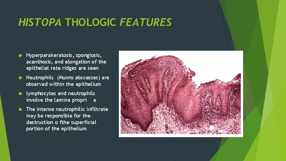 HISTOPA THOLOGIC FEATURES Hyperparakeratosis, spongiosis, acanthosis, and elongation of the epithelial rete ridges are HISTOPA THOLOGIC FEATURES Hyperparakeratosis, spongiosis, acanthosis, and elongation of the epithelial rete ridges are