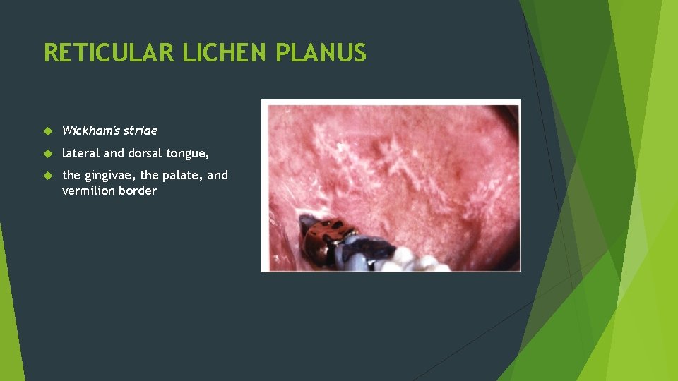 RETICULAR LICHEN PLANUS Wickham's striae lateral and dorsal tongue, the gingivae, the palate, and RETICULAR LICHEN PLANUS Wickham's striae lateral and dorsal tongue, the gingivae, the palate, and