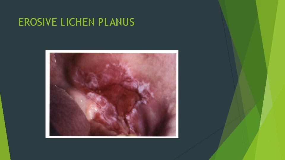 EROSIVE LICHEN PLANUS EROSIVE LICHEN PLANUS