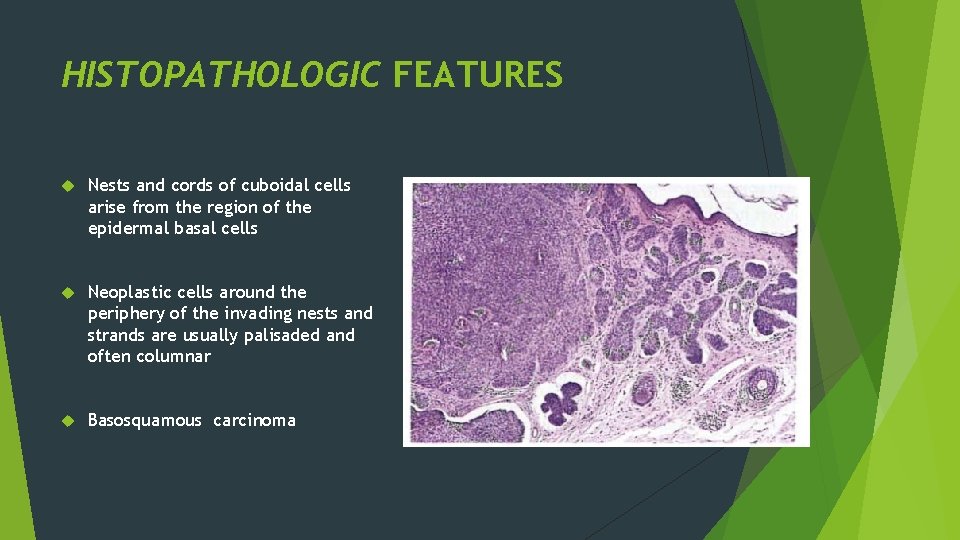 HISTOPATHOLOGIC FEATURES Nests and cords of cuboidal cells arise from the region of the