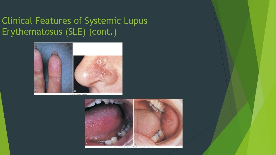 Clinical Features of Systemic Lupus Erythematosus (SLE) (cont. ) 