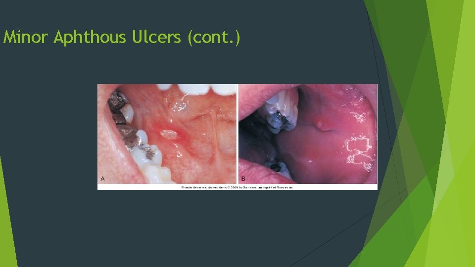 Minor Aphthous Ulcers (cont. ) Minor Aphthous Ulcers (cont. )