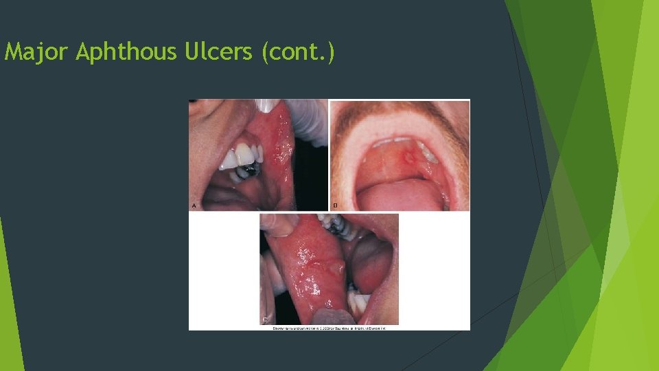 Major Aphthous Ulcers (cont. ) 