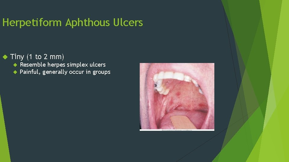 Herpetiform Aphthous Ulcers Tiny (1 to 2 mm) Resemble herpes simplex ulcers Painful, generally