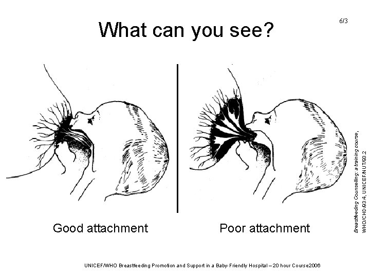 Poor attachment UNICEF/WHO Breastfeeding Promotion and Support in a Baby-Friendly Hospital – 20 hour Poor attachment UNICEF/WHO Breastfeeding Promotion and Support in a Baby-Friendly Hospital – 20 hour