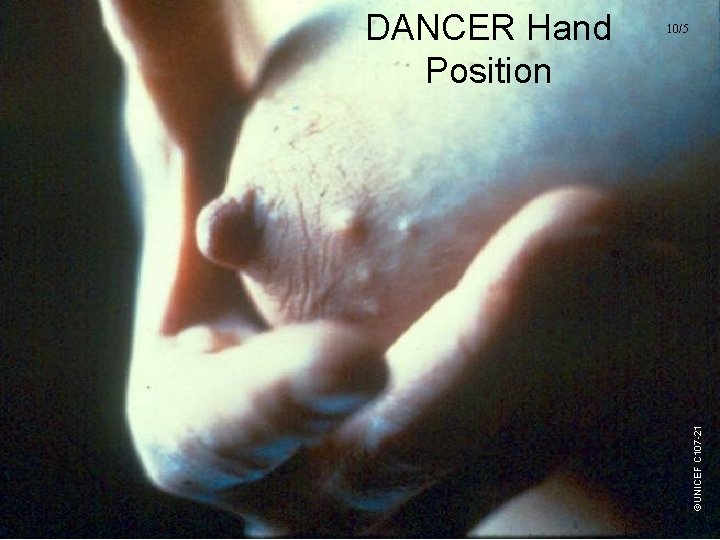 10/5 ©UNICEF C 107 -21 DANCER Hand Position UNICEF/WHO Breastfeeding Promotion and Support in 10/5 ©UNICEF C 107 -21 DANCER Hand Position UNICEF/WHO Breastfeeding Promotion and Support in