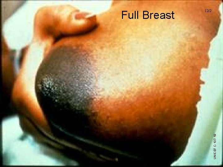 UNICEF/WHO Breastfeeding Promotion and Support in a Baby-Friendly Hospital – 20 hour Course 2006 UNICEF/WHO Breastfeeding Promotion and Support in a Baby-Friendly Hospital – 20 hour Course 2006
