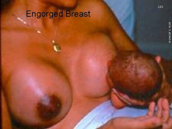 12/3 © UNICEF C-10 -25 Engorged Breast UNICEF/WHO Breastfeeding Promotion and Support in a 12/3 © UNICEF C-10 -25 Engorged Breast UNICEF/WHO Breastfeeding Promotion and Support in a