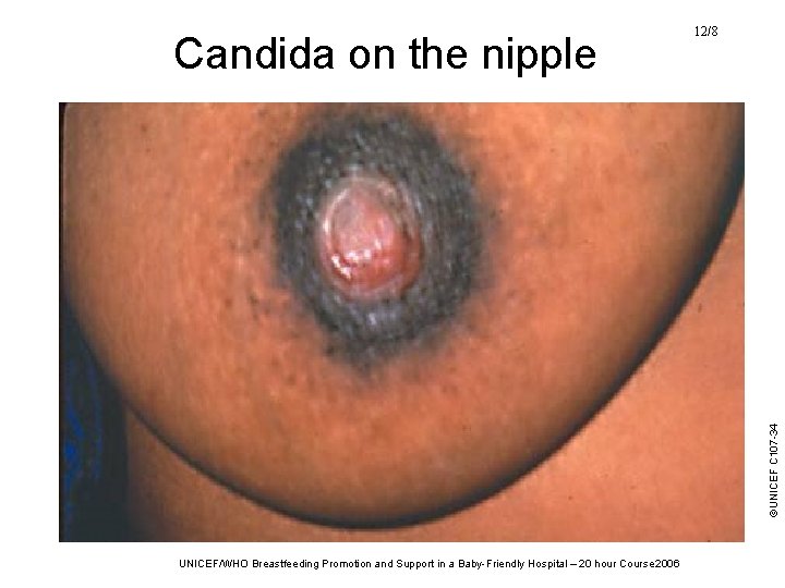 ©UNICEF C 107 -34 Candida on the nipple 12/8 UNICEF/WHO Breastfeeding Promotion and Support ©UNICEF C 107 -34 Candida on the nipple 12/8 UNICEF/WHO Breastfeeding Promotion and Support