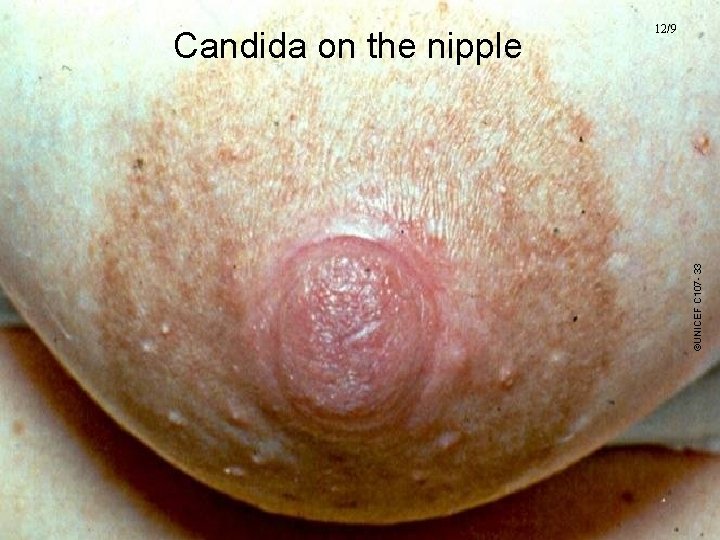 ©UNICEF C 107 - 33 Candida on the nipple 12/9 UNICEF/WHO Breastfeeding Promotion and ©UNICEF C 107 - 33 Candida on the nipple 12/9 UNICEF/WHO Breastfeeding Promotion and