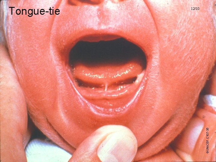 ©UNICEF C 107 -35 Tongue-tie 12/10 UNICEF/WHO Breastfeeding Promotion and Support in a Baby-Friendly ©UNICEF C 107 -35 Tongue-tie 12/10 UNICEF/WHO Breastfeeding Promotion and Support in a Baby-Friendly