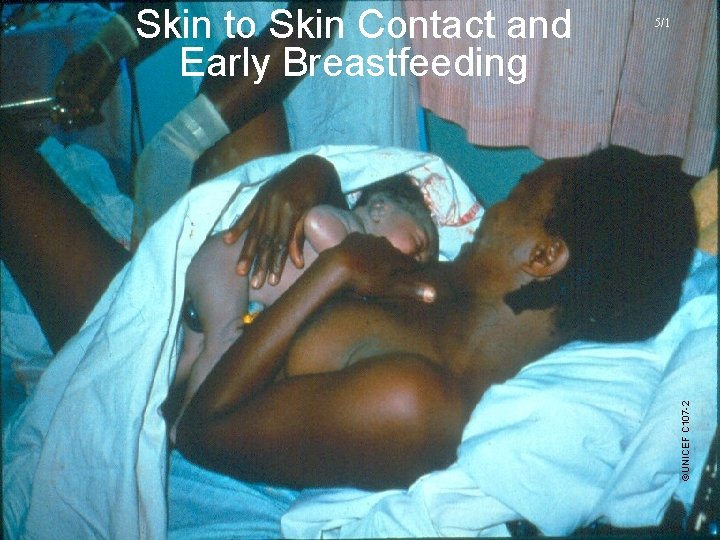 5/1 ©UNICEF C 107 -2 Skin to Skin Contact and Early Breastfeeding UNICEF/WHO Breastfeeding 5/1 ©UNICEF C 107 -2 Skin to Skin Contact and Early Breastfeeding UNICEF/WHO Breastfeeding