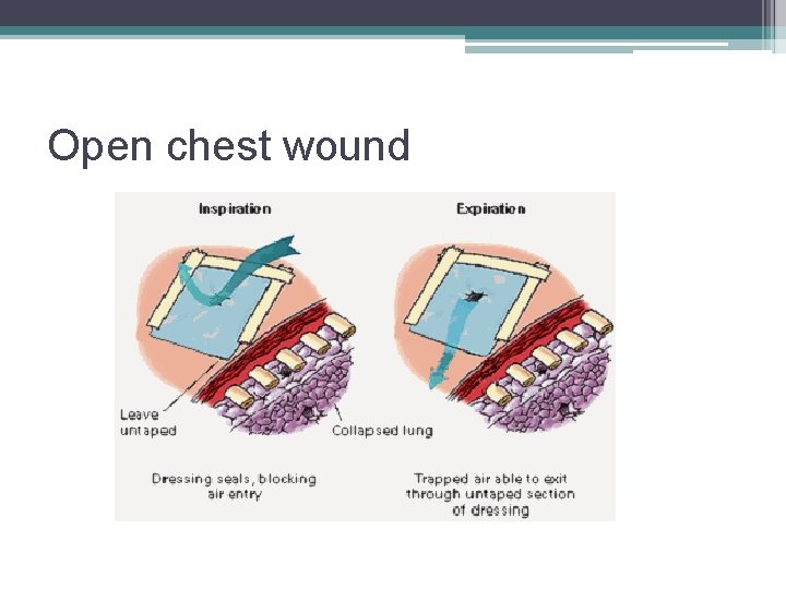 Open chest wound 