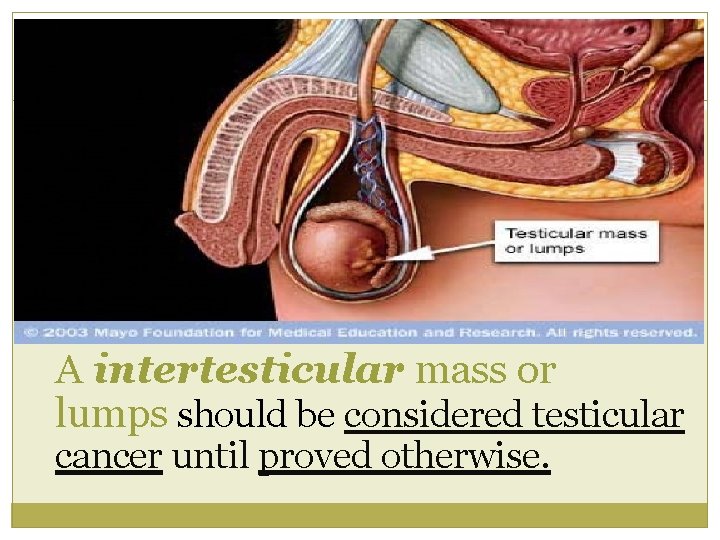 A intertesticular mass or lumps should be considered testicular cancer until proved otherwise. 