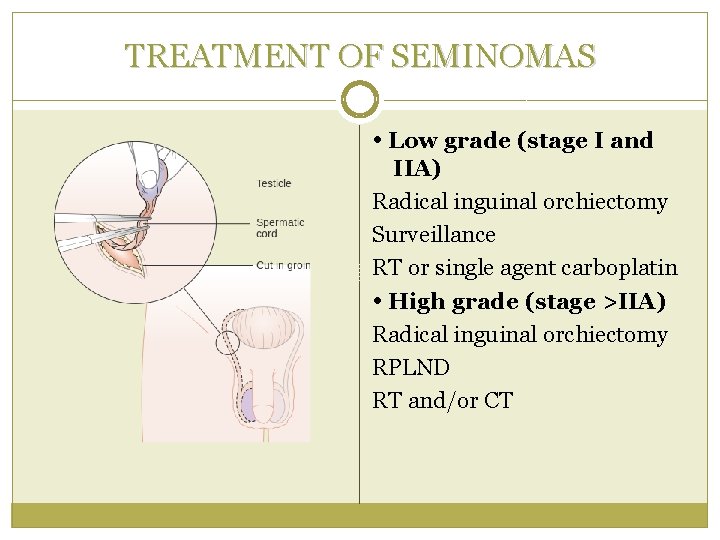 TREATMENT OF SEMINOMAS Low grade (stage I and IIA) Radical inguinal orchiectomy Surveillance RT