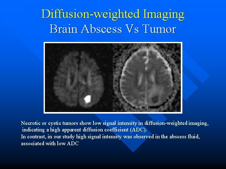 Diffusion-weighted Imaging Brain Abscess Vs Tumor Necrotic or cystic tumors show low signal intensity