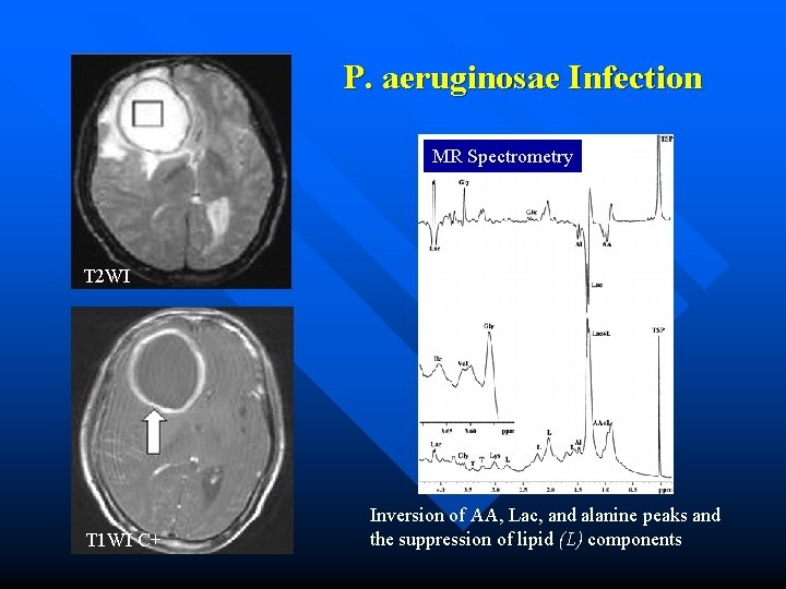 P. aeruginosae Infection MR Spectrometry T 2 WI T 1 WI C+ Inversion of