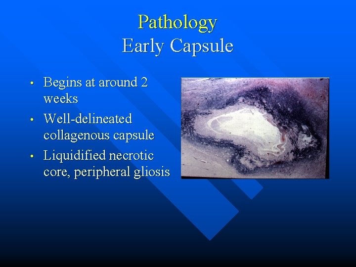 Pathology Early Capsule • • • Begins at around 2 weeks Well-delineated collagenous capsule