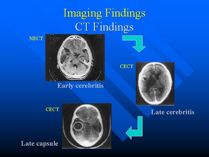 Imaging Findings CT Findings NECT CECT Early cerebritis CECT Late capsule Late cerebritis 
