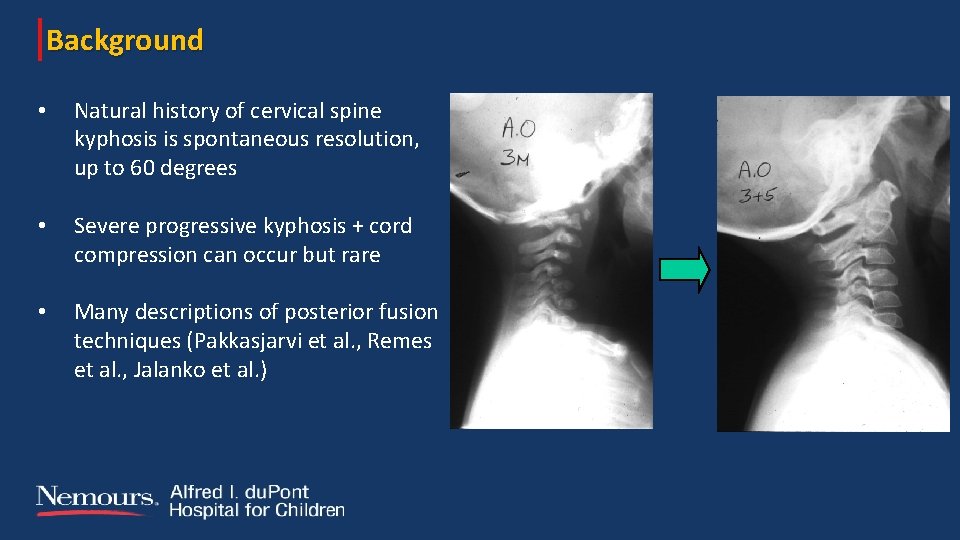 Background • Natural history of cervical spine kyphosis is spontaneous resolution, up to 60