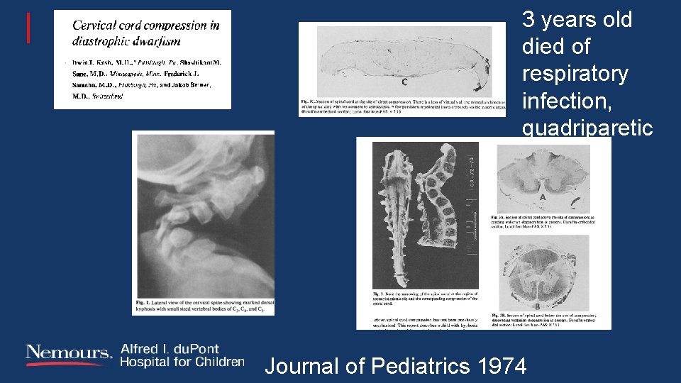 3 years old died of respiratory infection, quadriparetic Journal of Pediatrics 1974 