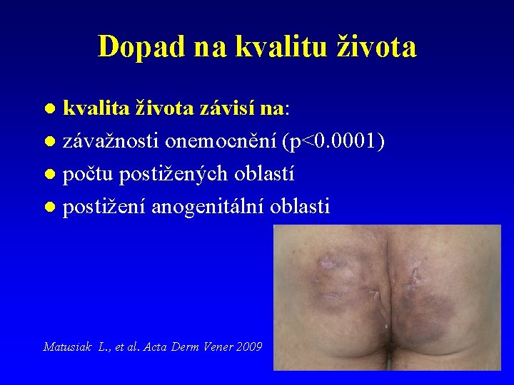 Dopad na kvalitu života kvalita života závisí na: l závažnosti onemocnění (p<0. 0001) l Dopad na kvalitu života kvalita života závisí na: l závažnosti onemocnění (p<0. 0001) l